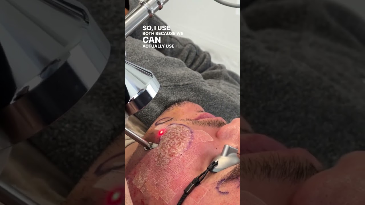 The MOST Effective Acne Scar Treatment in 2023!
