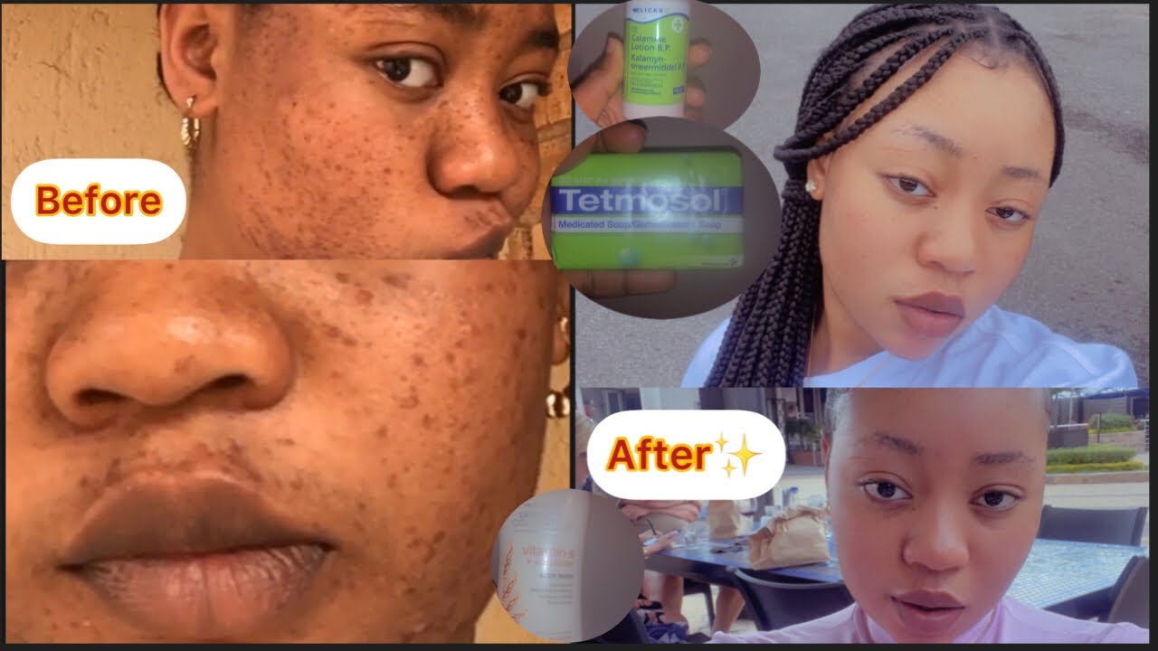 How to get rid of acne.(my skincare routine for acne)#acne#pimples#breakout