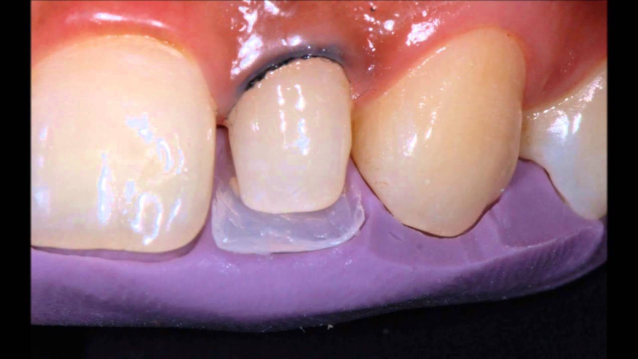 Dr Anthony Tay - 3M ESPE Filtek Z350XT Anterior Composite Layering of a Peg Lateral Incisor