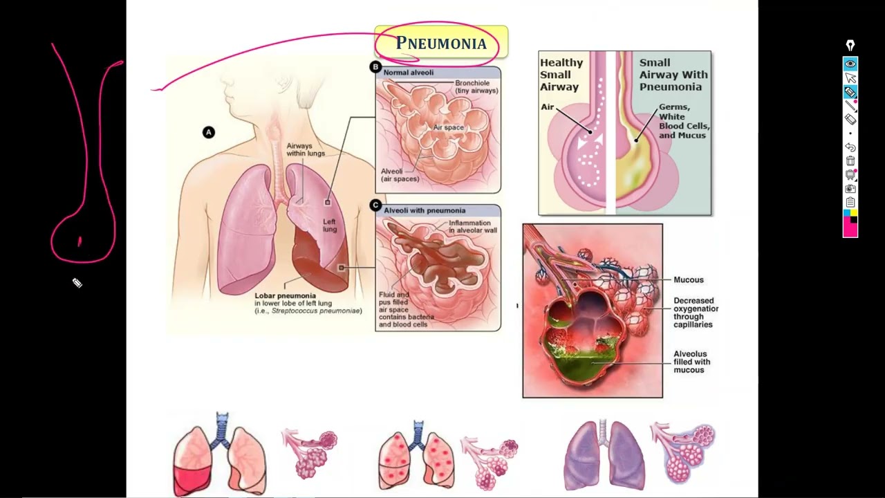 3-Pneumonia, lung abscess, collapse & fibrosis شرح باطنة دكتور سويلم
