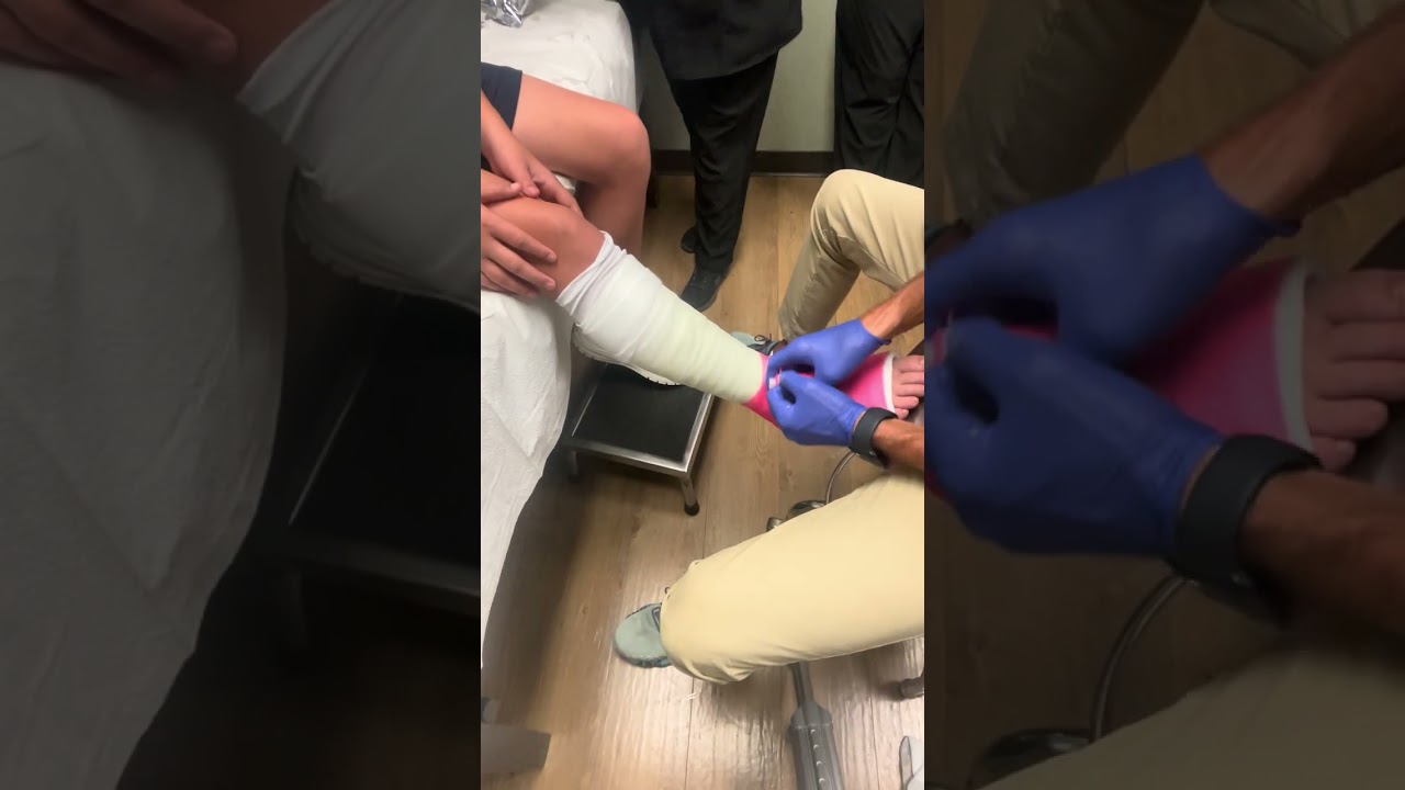 SHORT LEG WALKING CAST