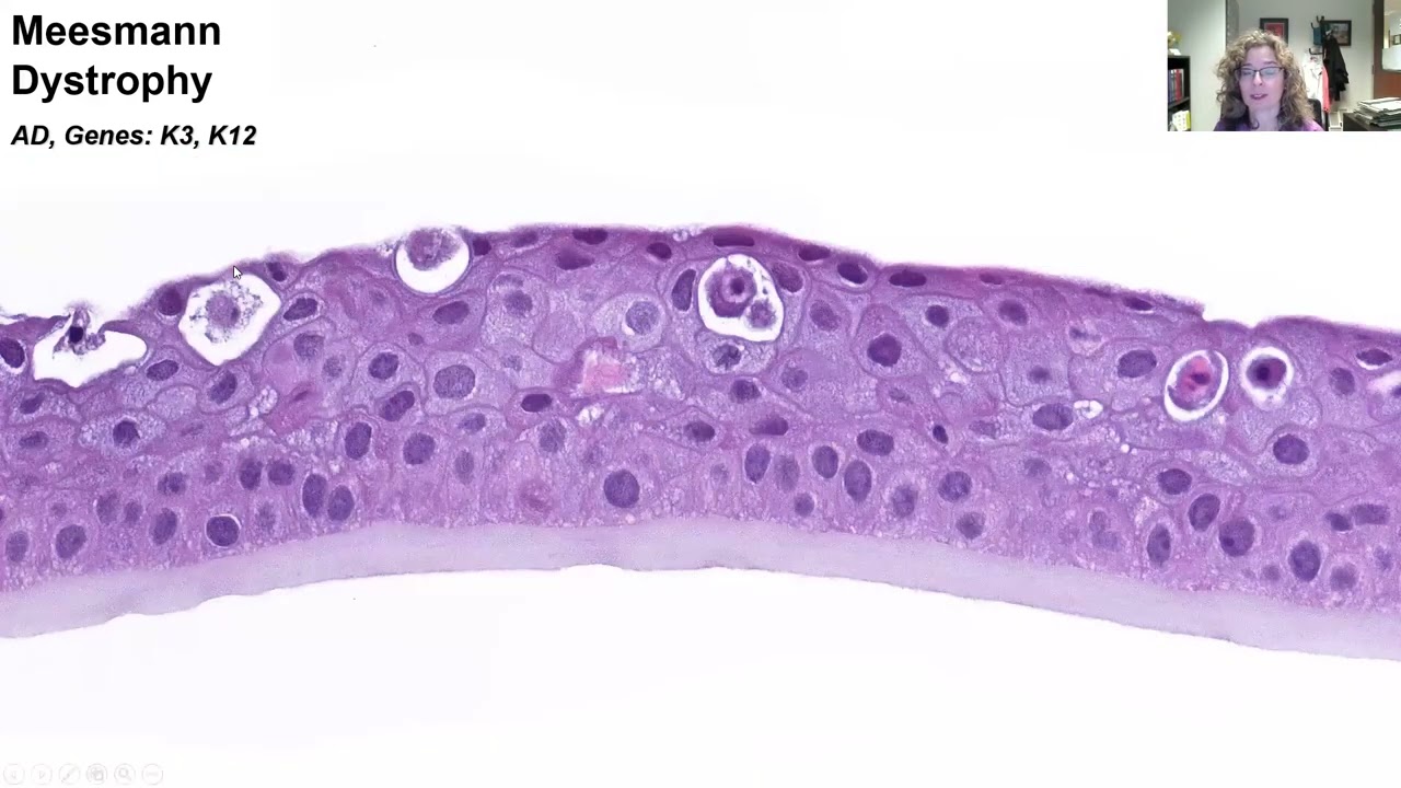 AANP Teaching Rounds - May 22, 2023 - Corneal Dystrophies and Simulating Lesions