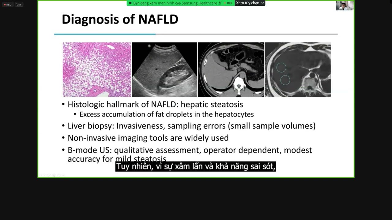 Quantitative Ultrasound (QUS) for Assessing Hepatic Steatosis