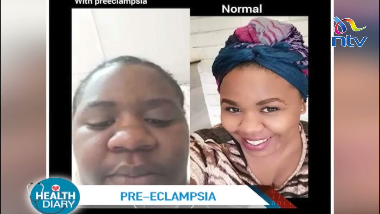 Understanding pre-eclampsia || Health Diary