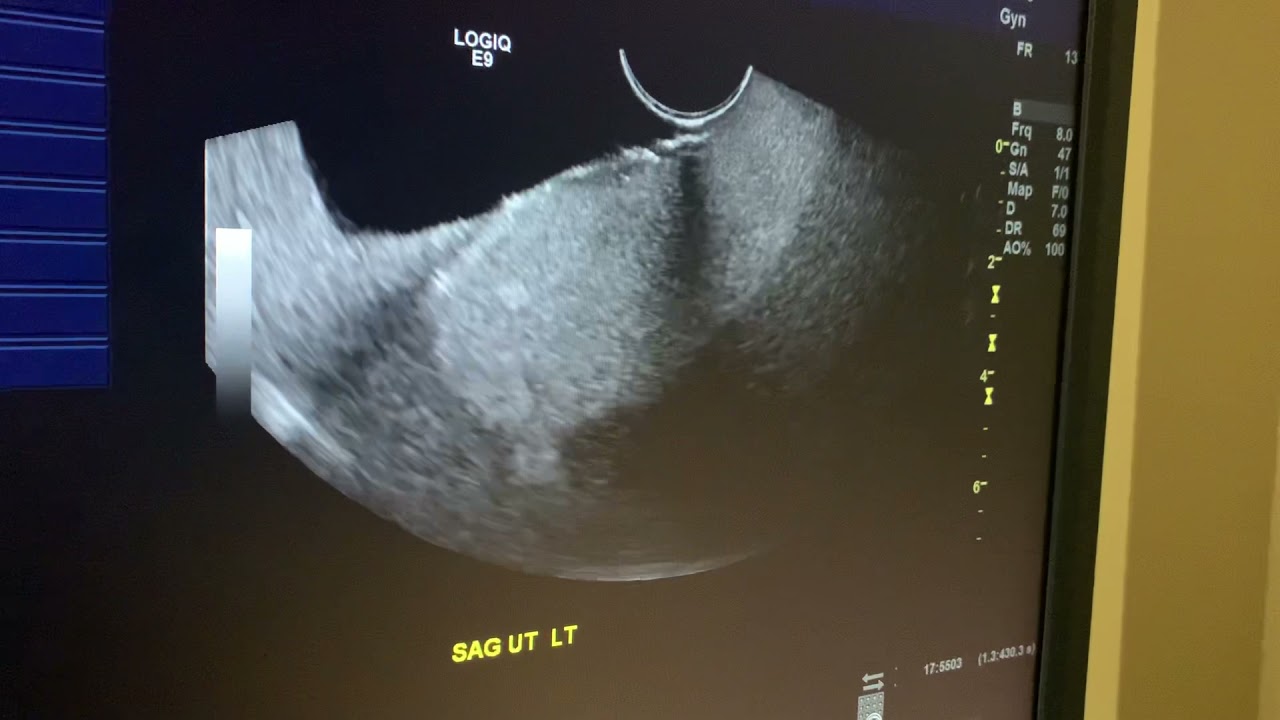 Pelvic transvaginal ultrasound for beginners