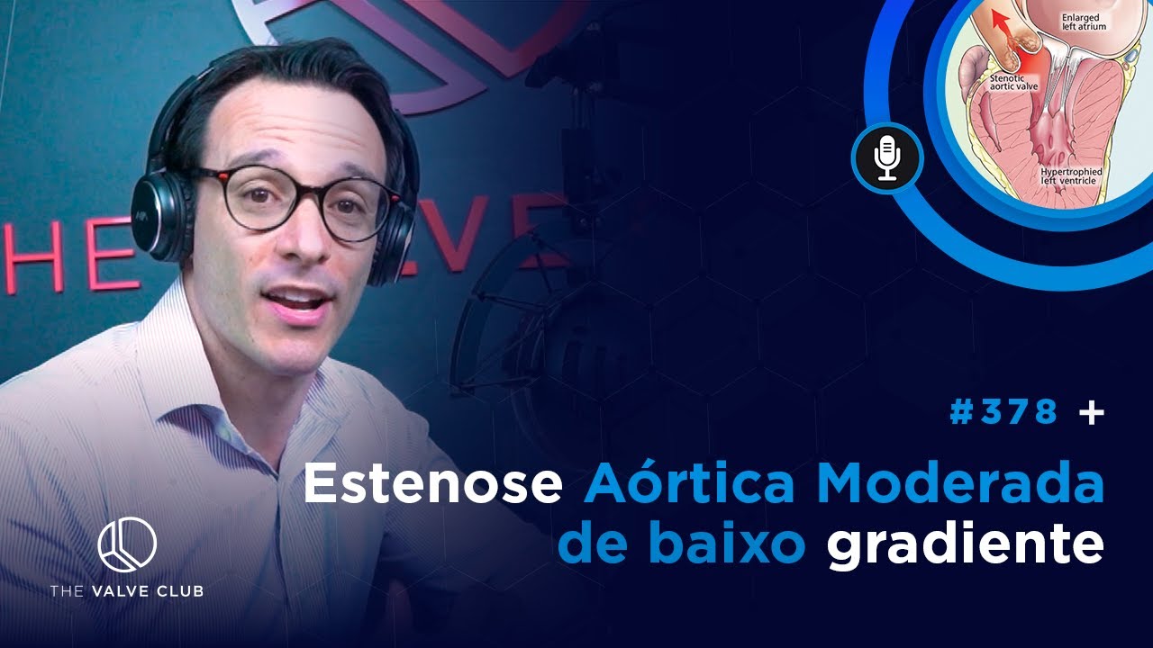 Click Valvar #378 - Estenose Aórtica Moderada de baixo gradiente