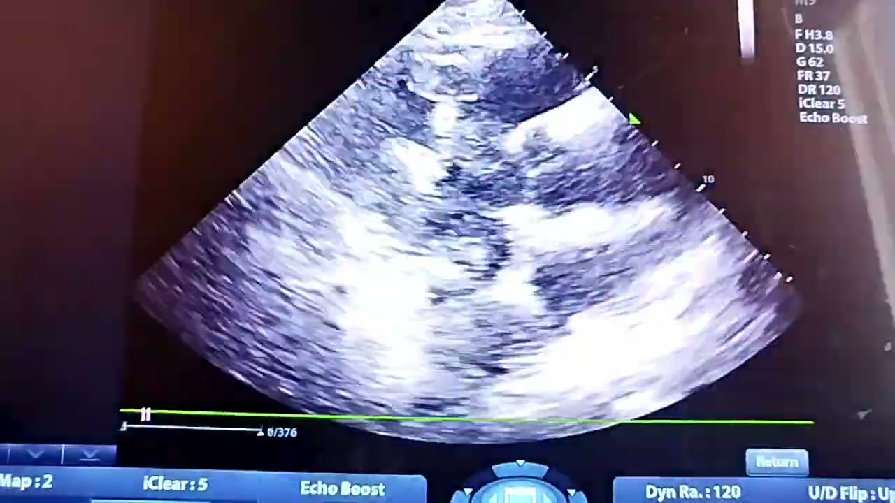 A kinetic Apex and apicoseptum