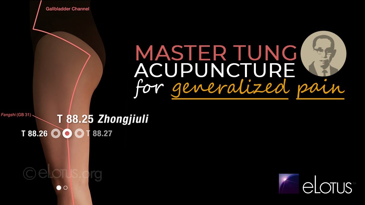 Chinese Formulas and Master Tung point for Generalized Pain | Acupuncture CEUs/PDAs