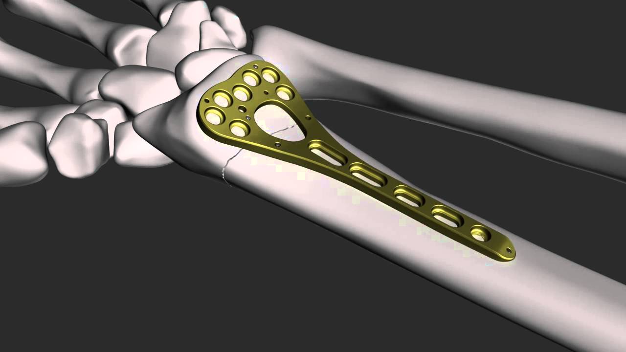 Visido - 3D Medical Animation - Volar Distal Radial Plate
