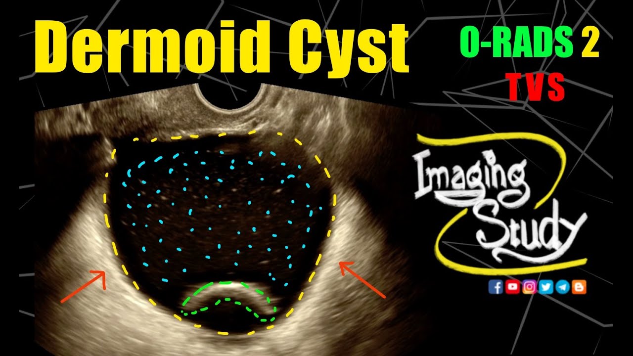 Adnexal Dermoid Cyst | Mature Cystic Teratoma | ORADS 2 || Ultrasound | TVS || Case 316
