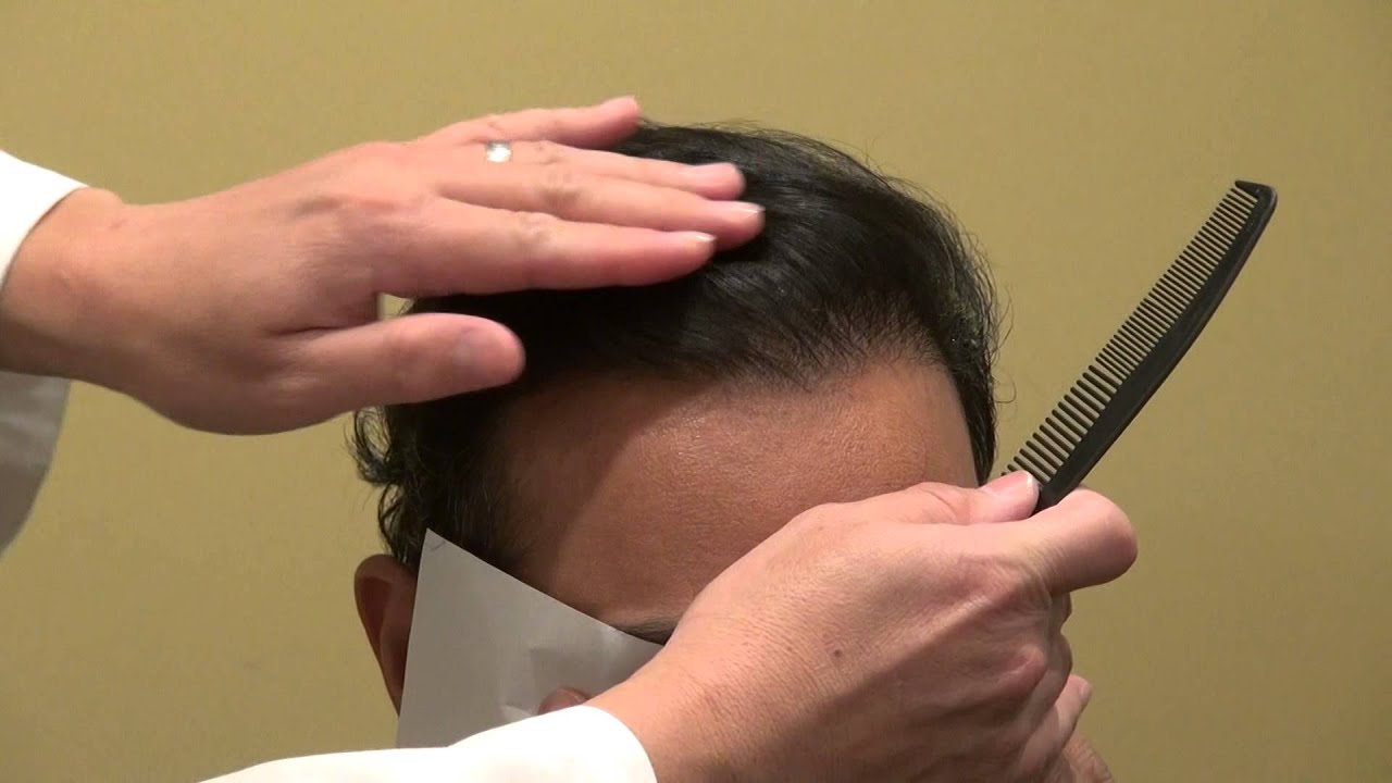 Receding Hairline Transplant Restoration Surgery 1 Yr Result Dr. Diep www.mhtaclinic.com