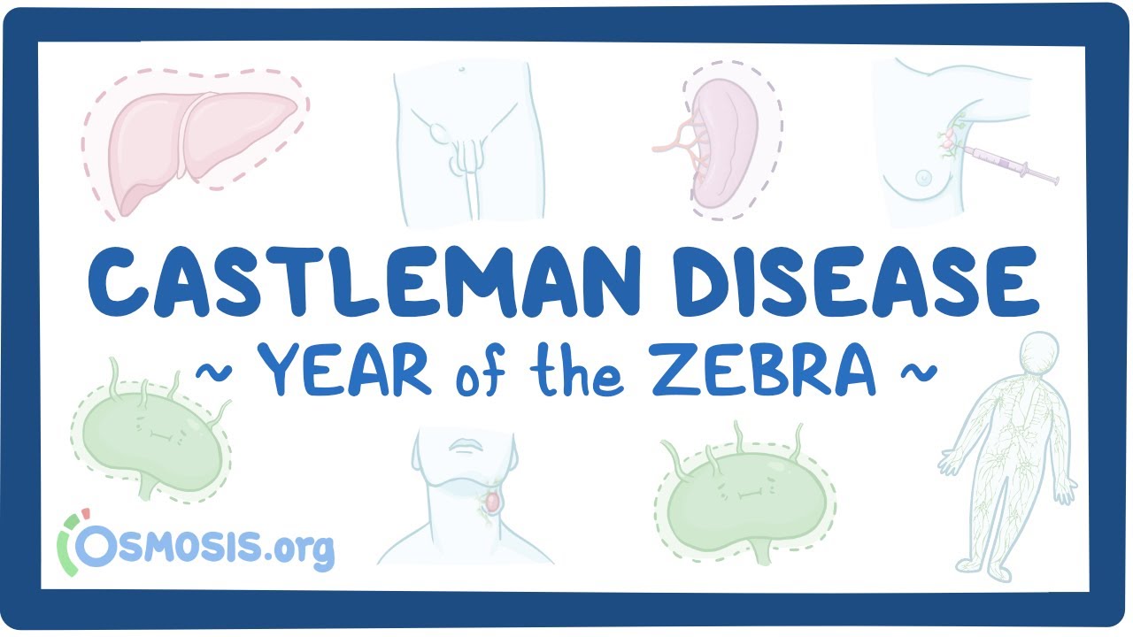Castleman disease (Year of the Zebra)