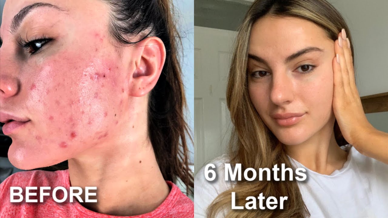 My Journey On Accutane & SKINCARE ROUTINE! Krissy Cela
