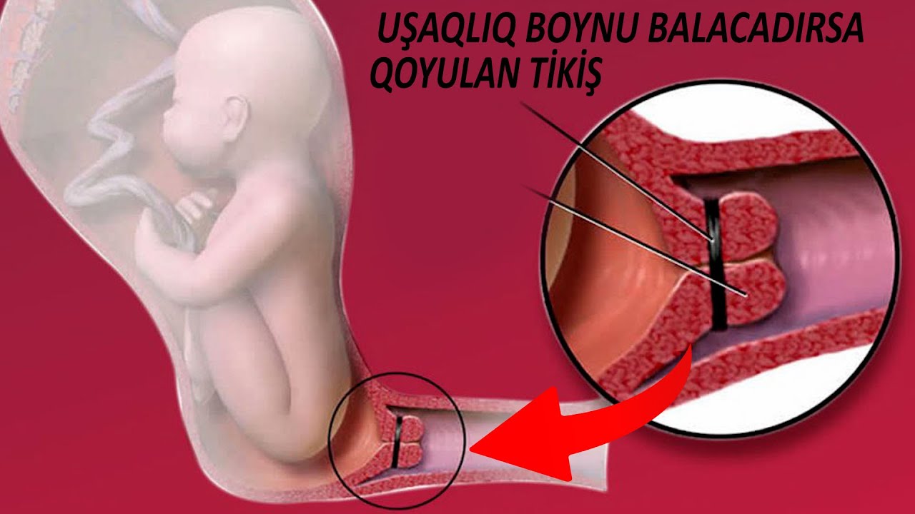 Uşaqlıq boynuna tikiş qoymaq - Qadınlar izləsin!