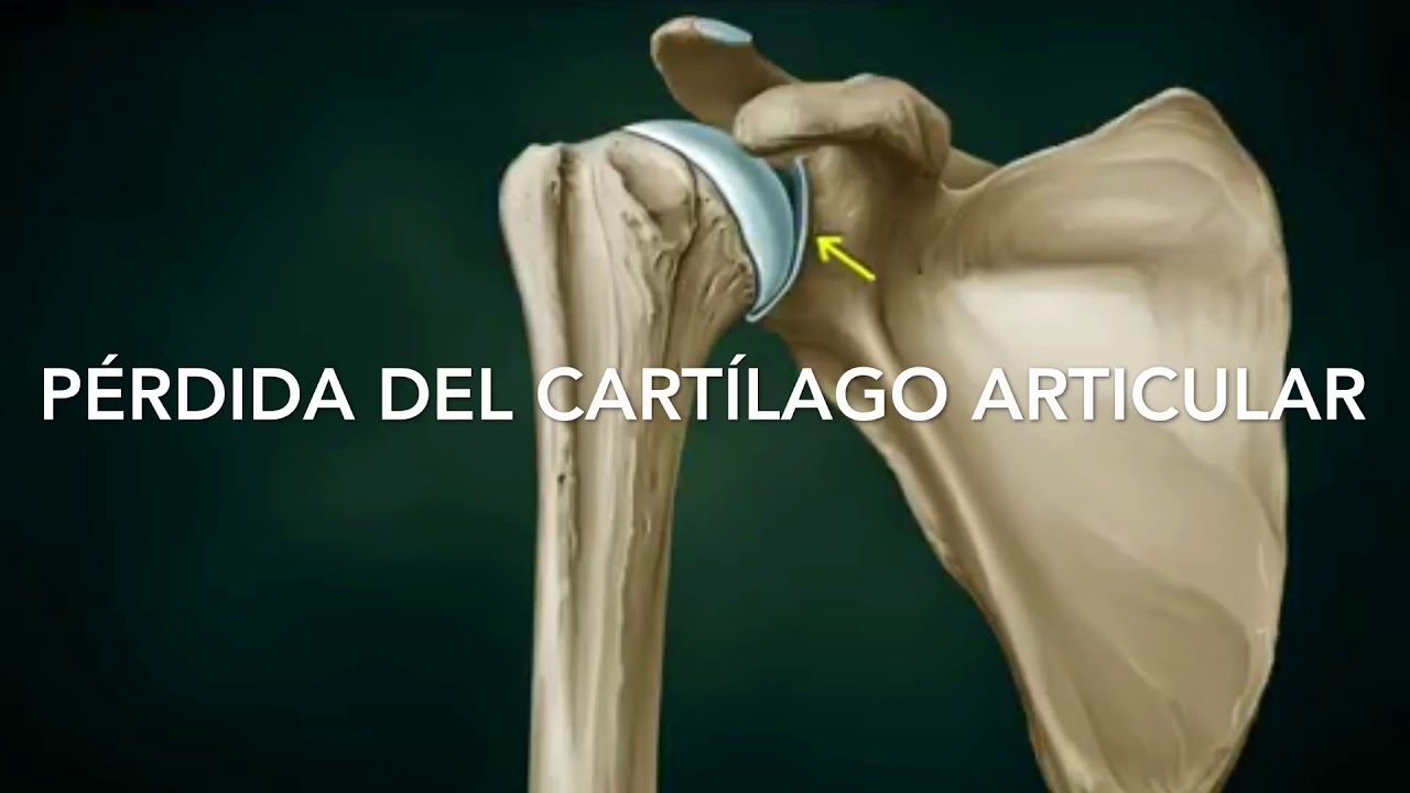 Artrosis de Hombro. Una enfermedad degenerativa y progresiva. Trátela con Ortopedia Regenerativa.
