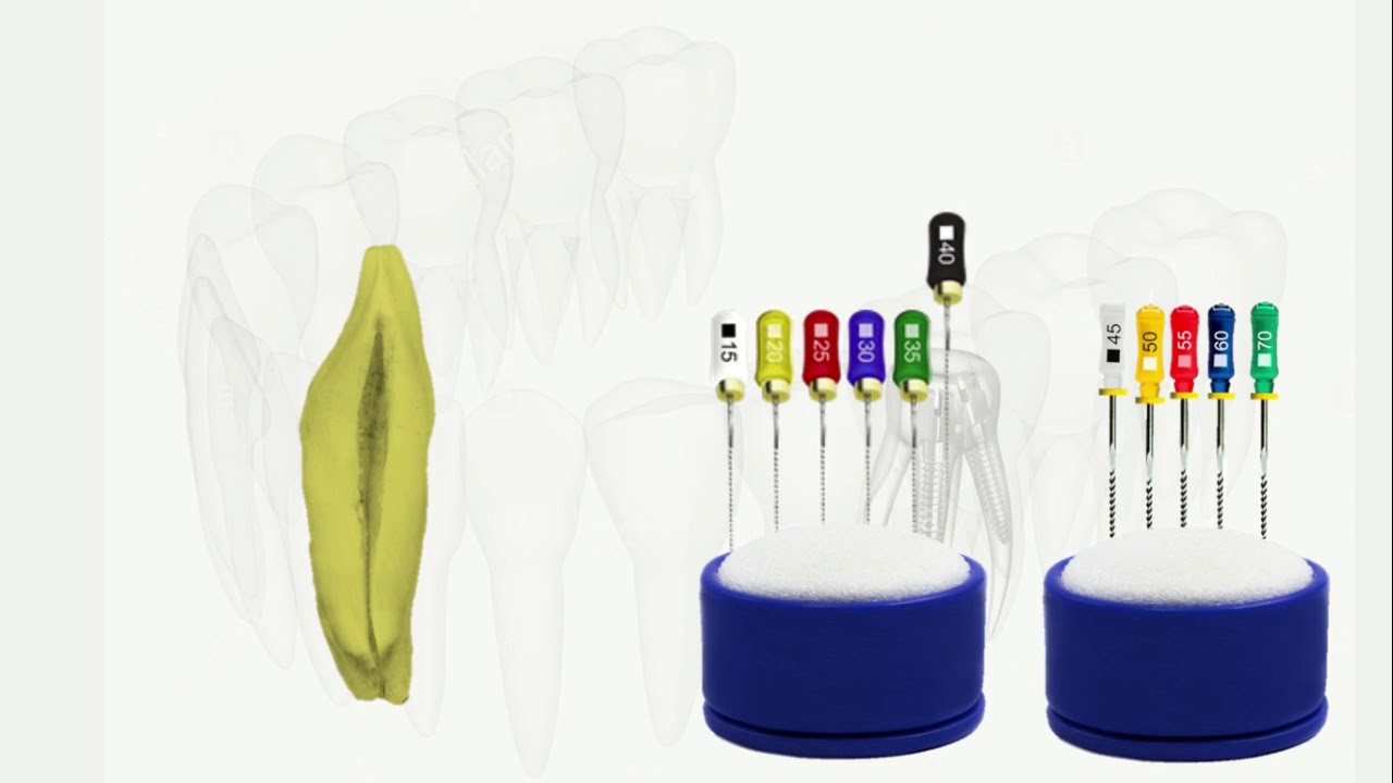 Técnica Crown Down, Instrumentación Endodoncia