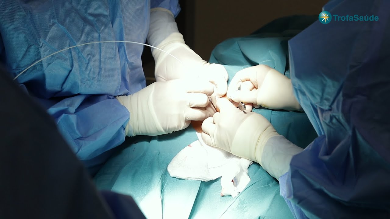 🔦 Laser para Hemorroidas? Conheça este tratamento inovador