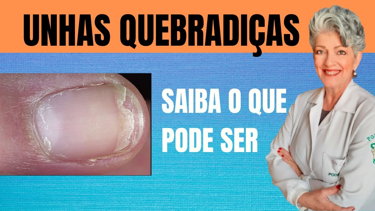 Você Tem as UNHAS QUEBRADIÇAS? Saiba as Causas e o Que Fazer