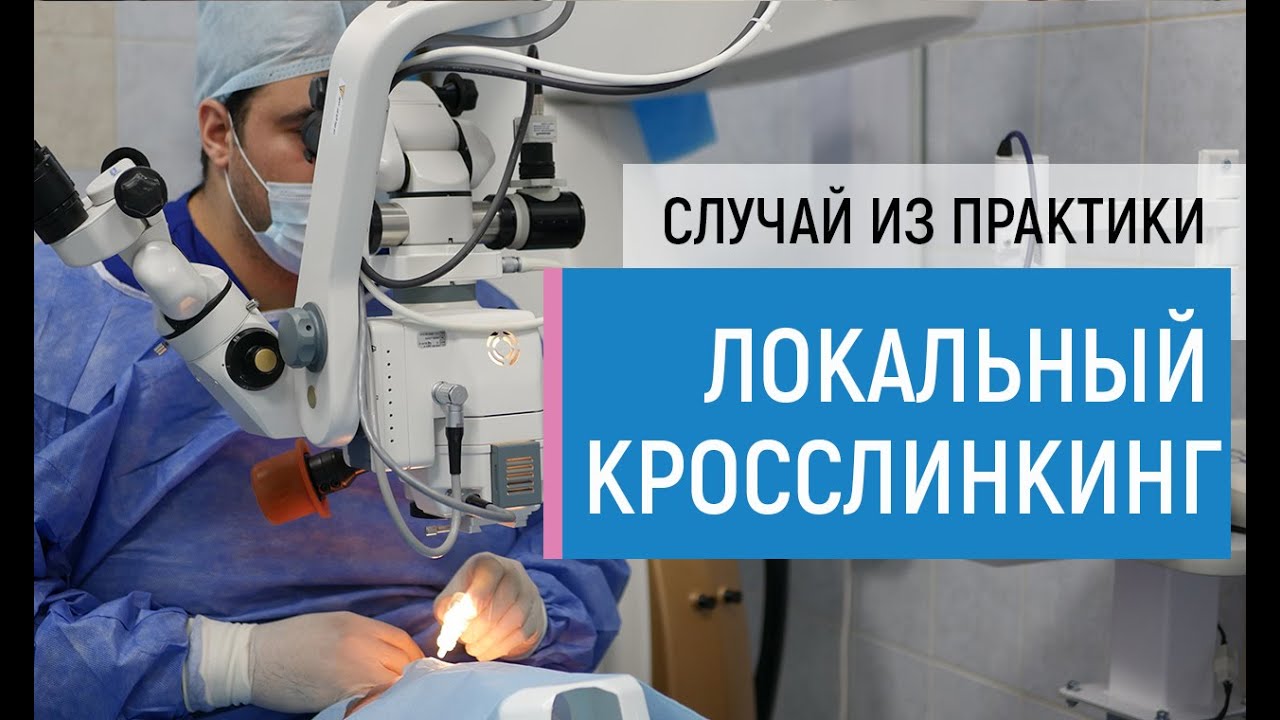 Операция локальный кросслинкинг по шагам. Случай из практики - лечение кератоконуса. Отзыв пациента.