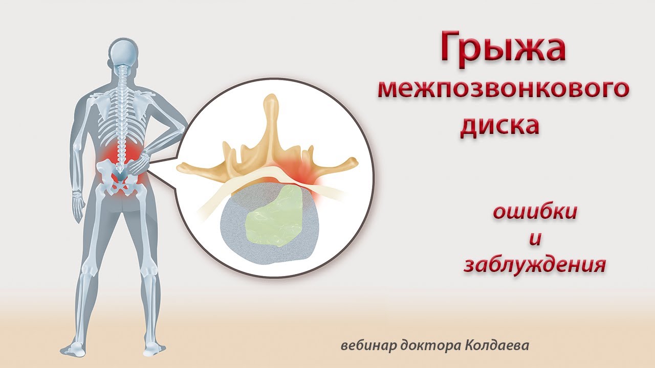 Грыжа диска