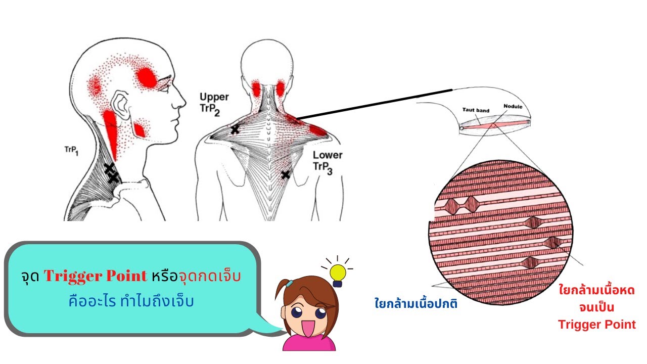 ทริกเกอร์พ้อยท์ อาการอาการปวดกล้ามเนื้อและพังผืด
