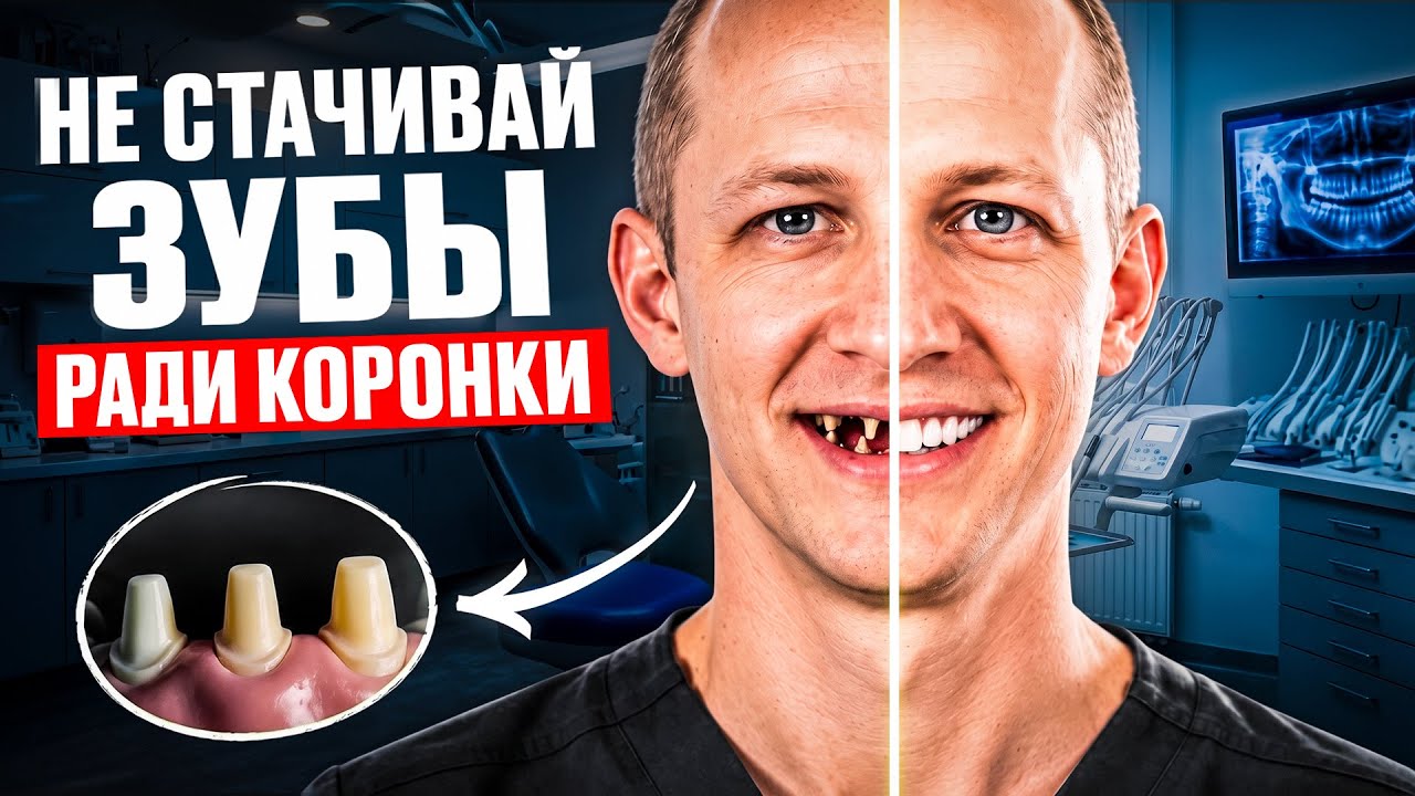 😁 Керамические коронки на передние зубы