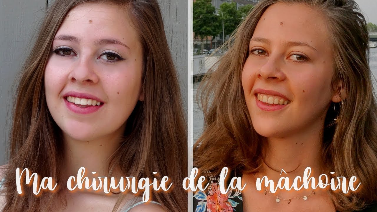 Ma chirurgie de la mâchoire (Ostéotomie maxillaire)