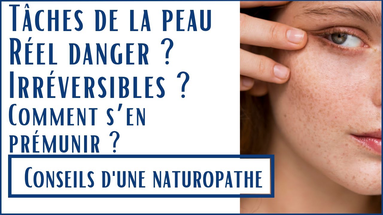 Les tâches du soleil ! Irréversible ? À quoi sont elles dues ? Comment se prémunir  ?