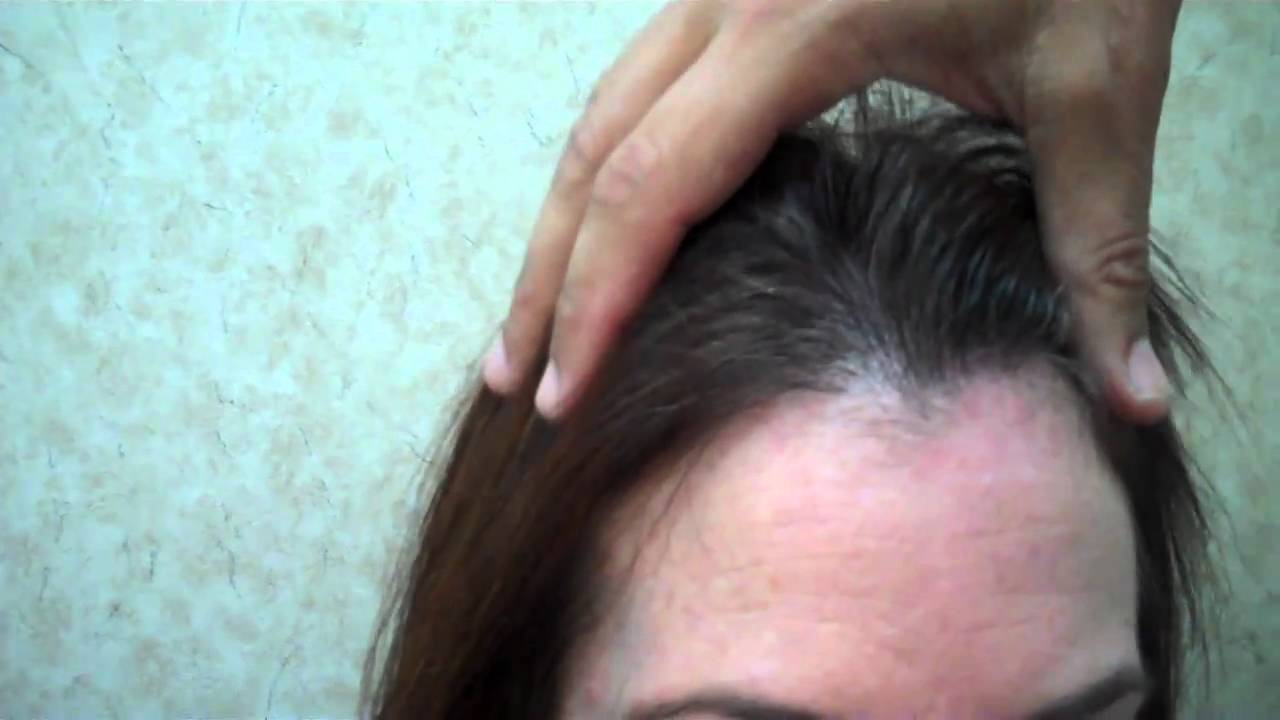 Dr. Jeffrey Epstein - Hair Transplant Procedure 11 months post-op - Female Patient