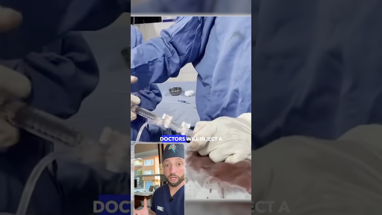 brain aneurysm rerupture. #nejm #medical #medtok #aneurysm #brain #neurosurgery #doctor