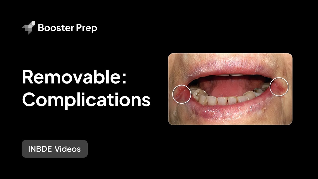 Prosthodontics | Removable: Complications | INBDE, NDEB, ADAT
