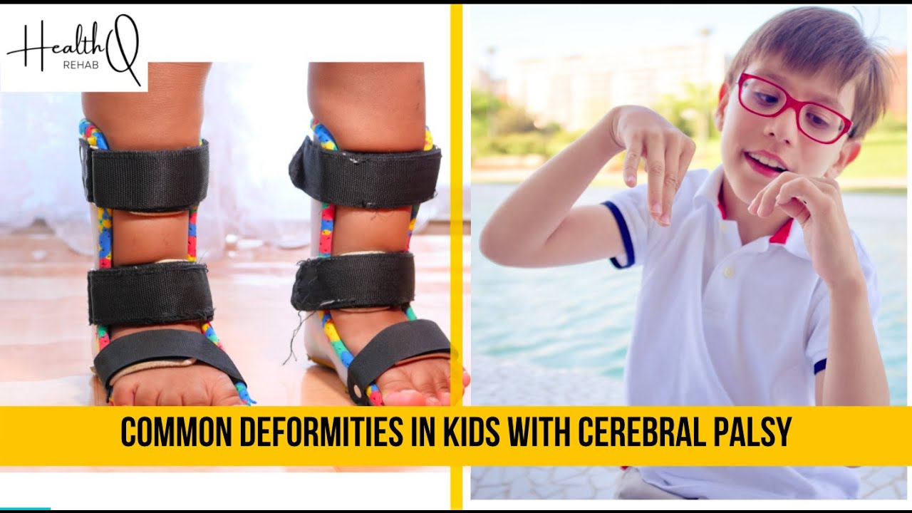 Common deformities among cerebral palsy kids