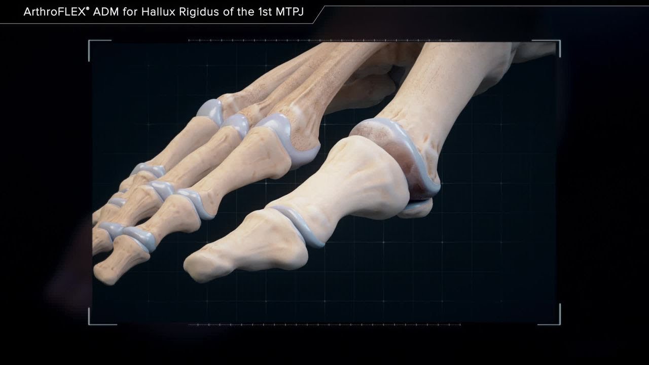 ArthroFLEX® ADM for Hallux Rigidus of the 1st MTPJ