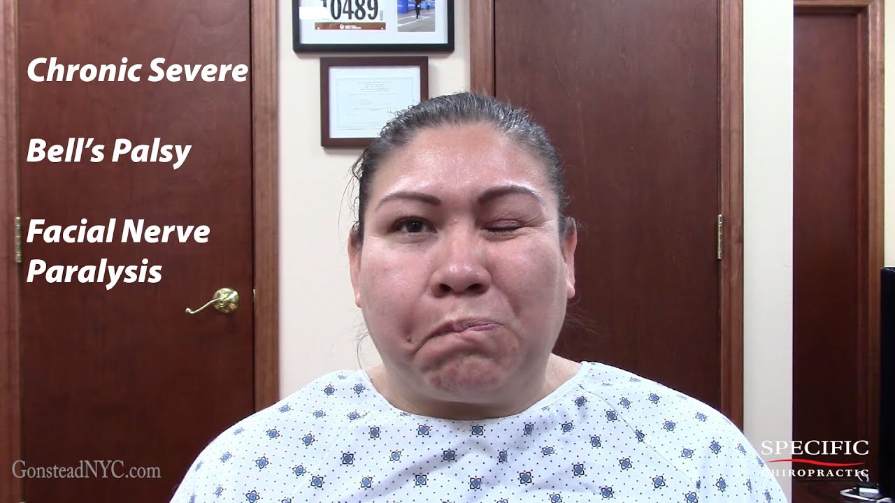 Chronic Severe Bell's Palsy, Facial Nerve Paralysis HELPED by Dr Suh Specific Chiropractic