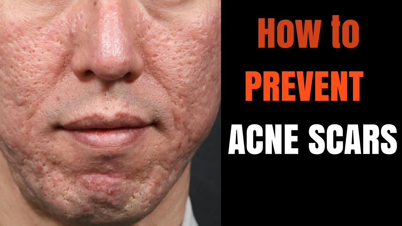 ACNE SCARS - how to prevent