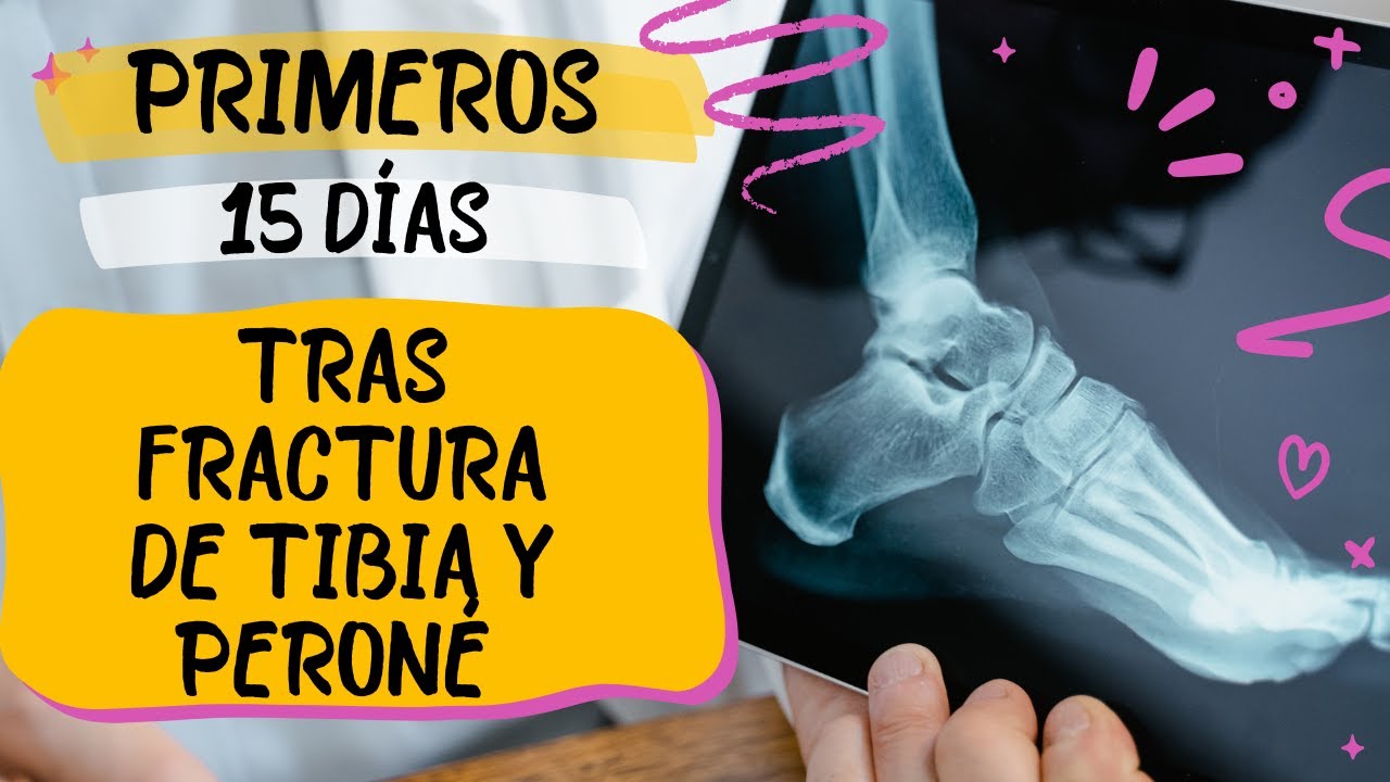 Fractura de tibia y peroné: primeros 15 días 
