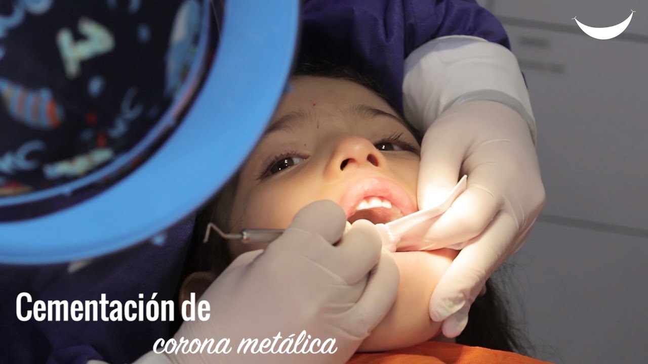 Corona dental en odontopediatría: