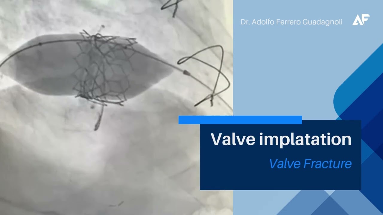 Reemplazo valvular Mitral percutaneo/transeptal | Dr. Adolfo Ferrero