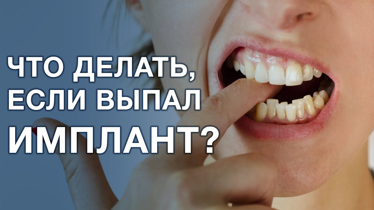 Что делать если выпал имплант зуба? Шатается имплант зуба.