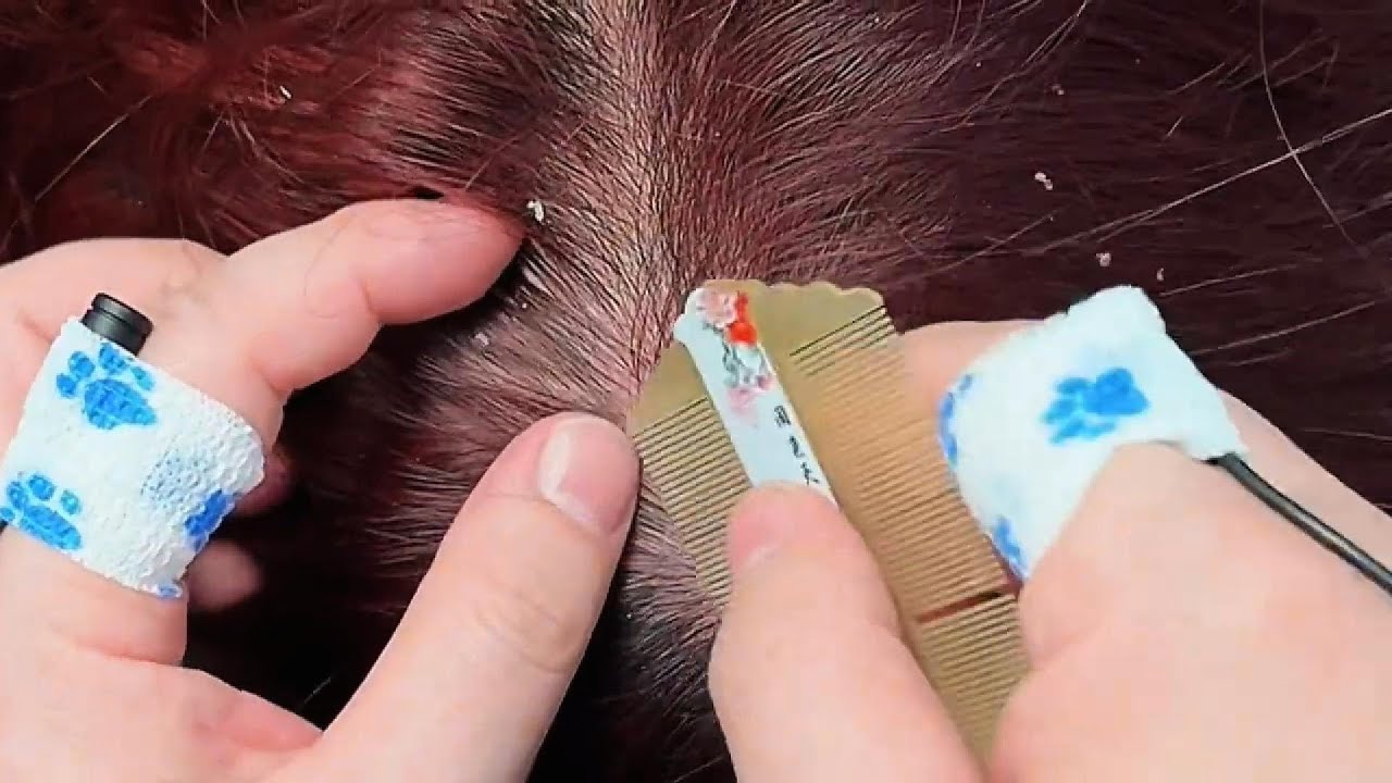 ASMR Effective Dandruff Removal with Comb & Nails – No Talking