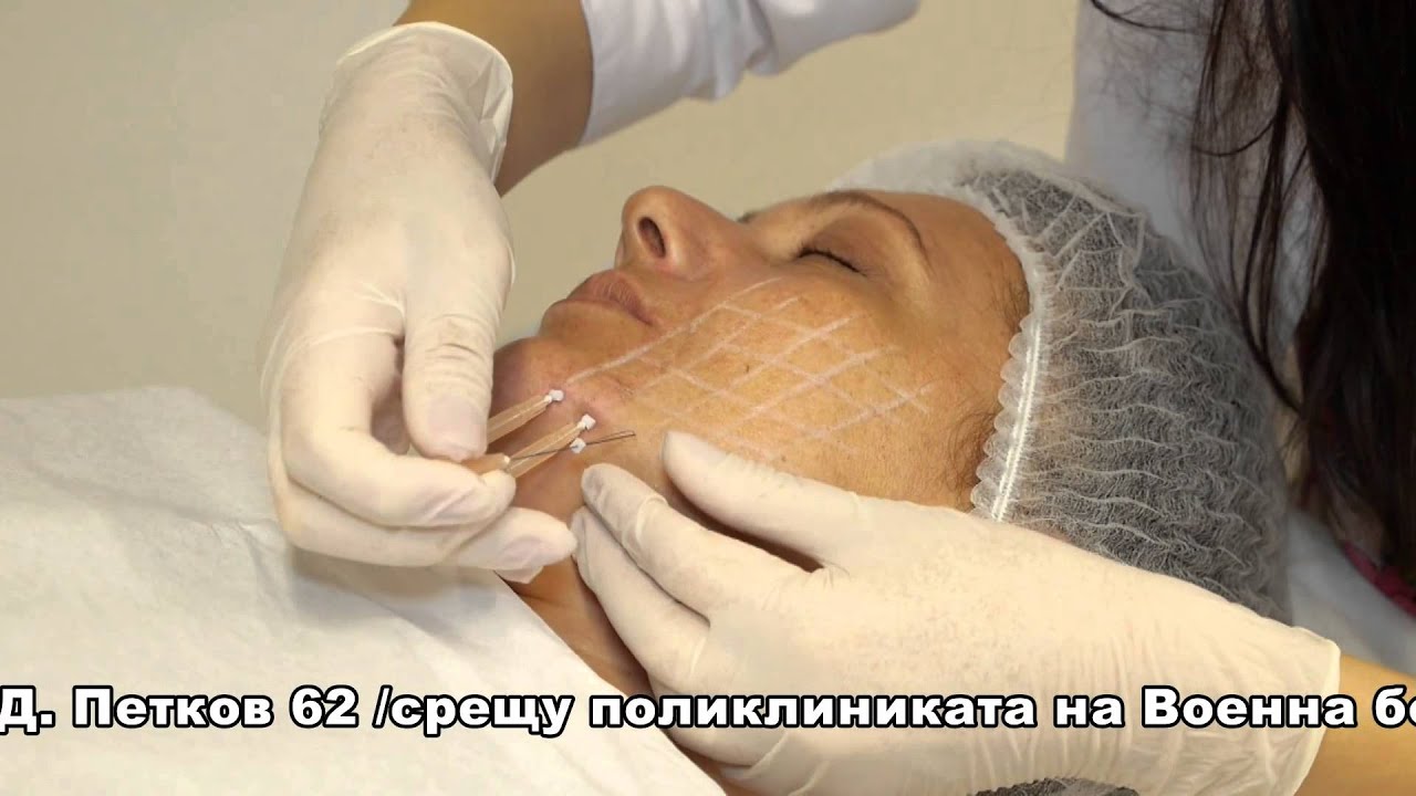 Мезоконци за лифтинг и подмладяване на кожата — Инканто