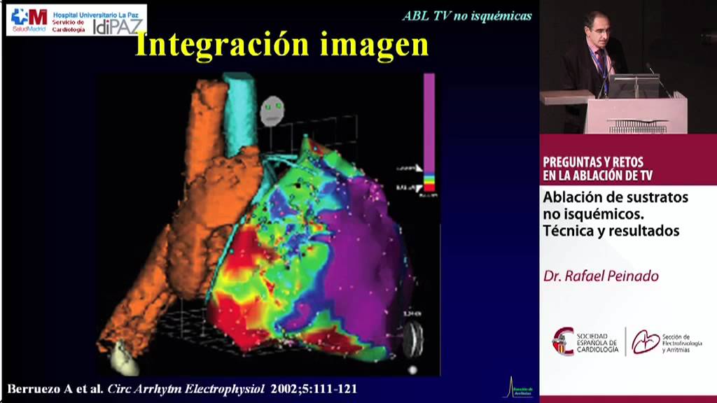 Ablación en sustratos no isquémicos. Técnica y resultados. Dr. Rafael Peinado