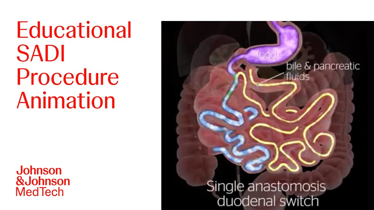 Animation of Single Anastomosis Duodenal Switch (SADI) Procedure | J&J MedTech