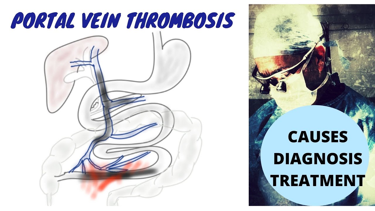 Portal Vein Thrombosis