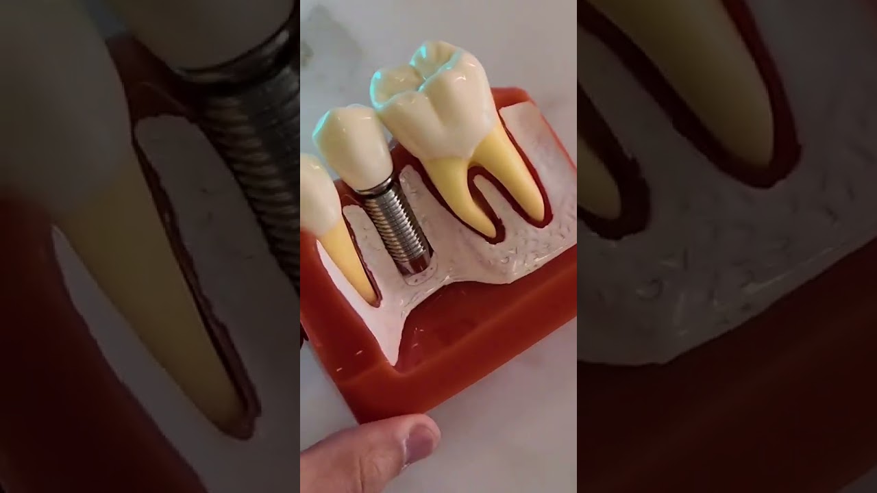 Qual o valor do implante?🦷