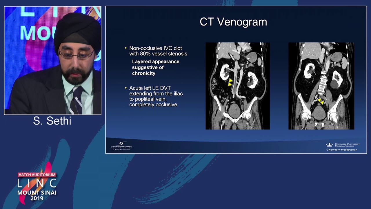 Hatch D1 - Iliac Vein Compression (May Thurner Syndrome) - Dr. Sethi