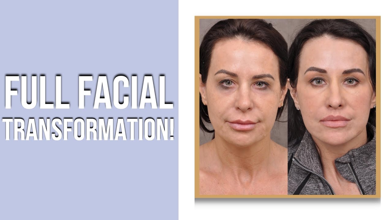 Full Face Transformation from Dr  Ben Talei of Beverly Hills Center for Plastic Surgery