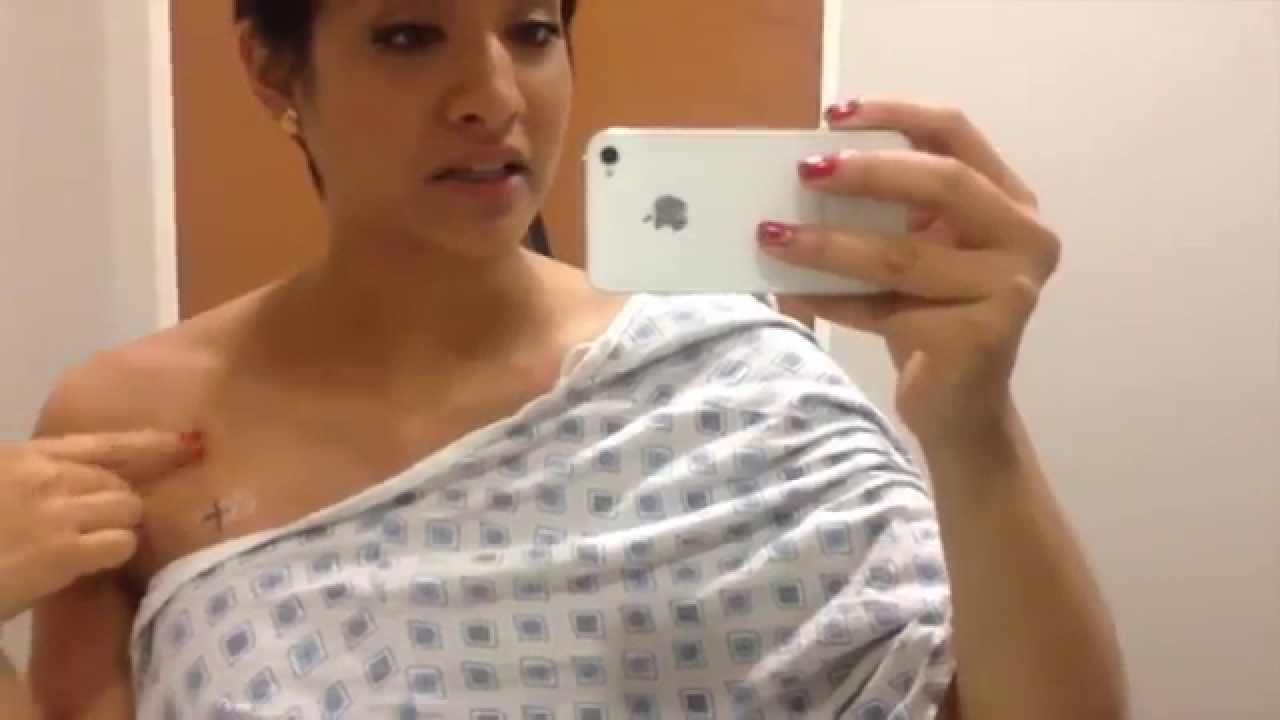 Breast Cancer Radiation Round 16-20: Good Haircut, Bad Tan.