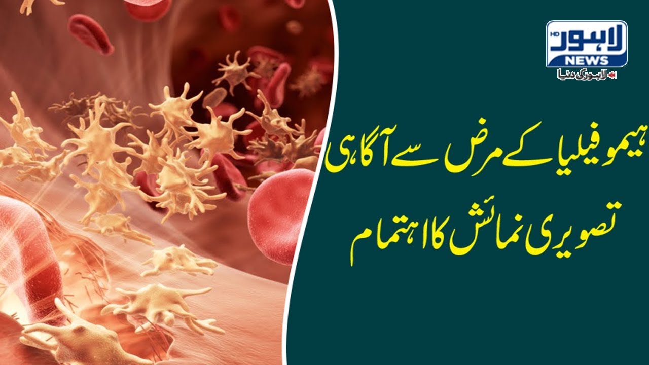Pakistan Hemophilia Welfare Society organizes photo exhibition