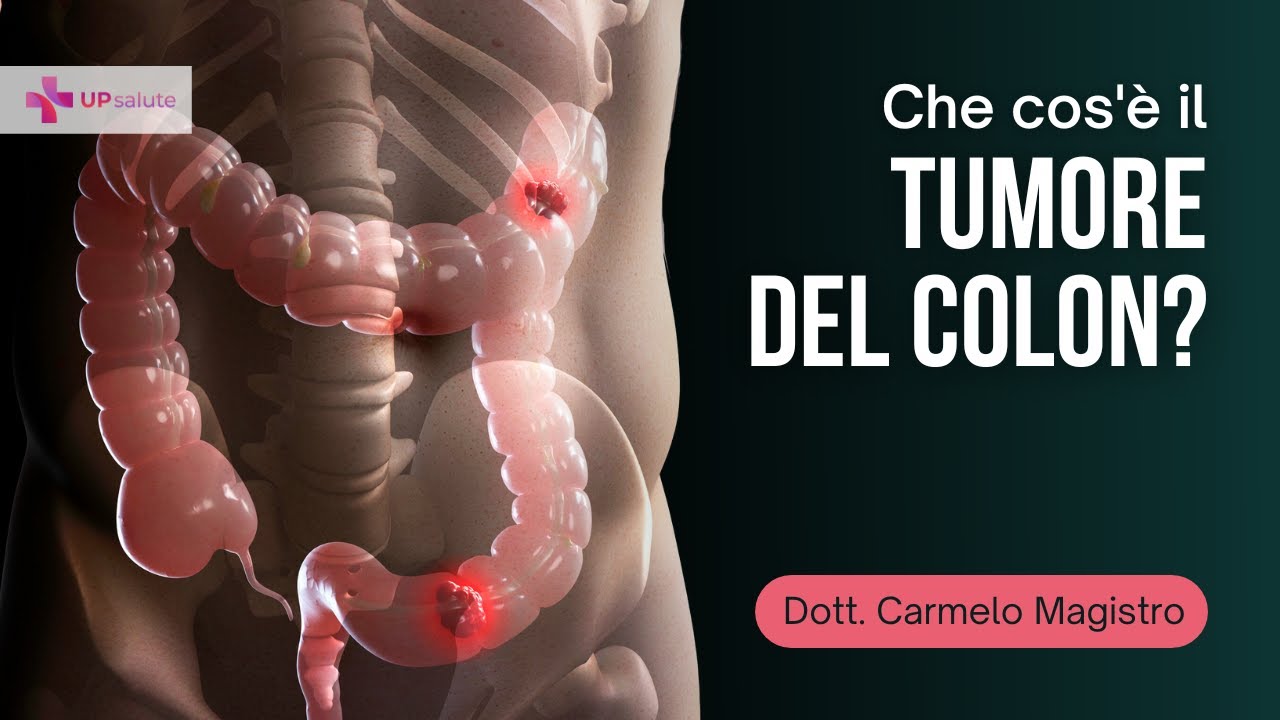 Tumore del colon - Dott. Carmelo Magistro - UPsalute Channel